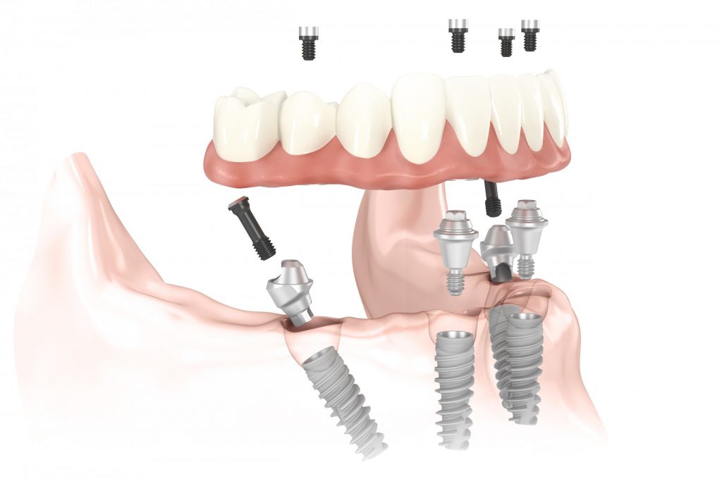 Вставить зубы в Симферополе - Протезы на имплантах