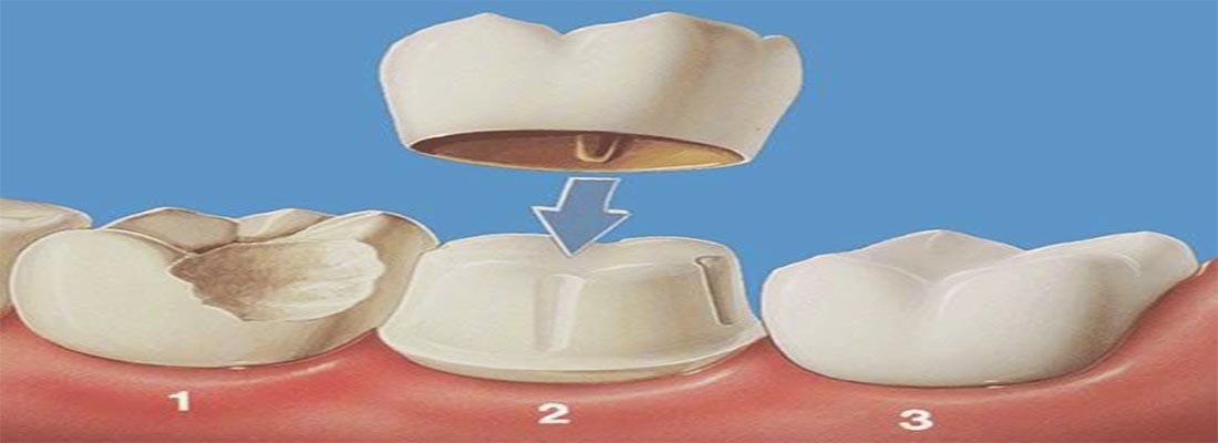 Восстановление сколотого зуба с помощью коронок