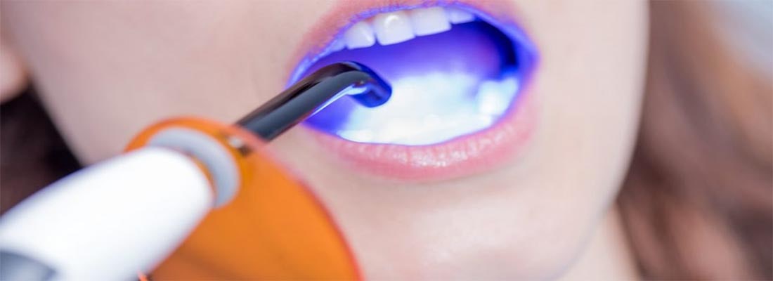Восстановление сколотого зуба с помощью склеивания