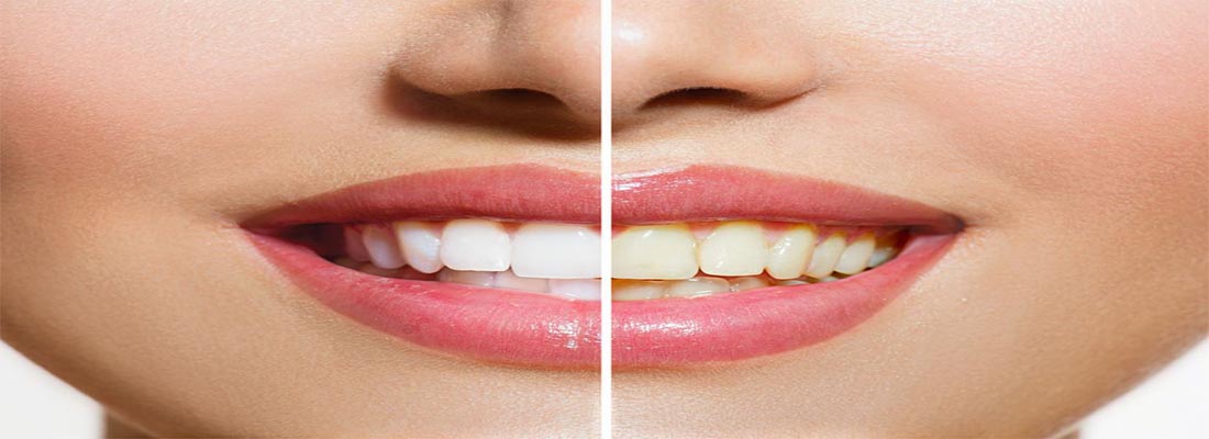 Как сохранить белизну зубов после отбеливания