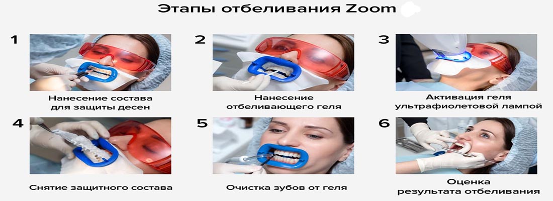 отбеливание зубов системой Zoom