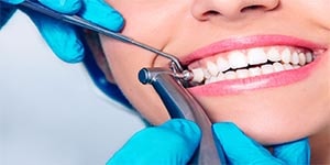 чистка зубов у стоматолога в Симферополе