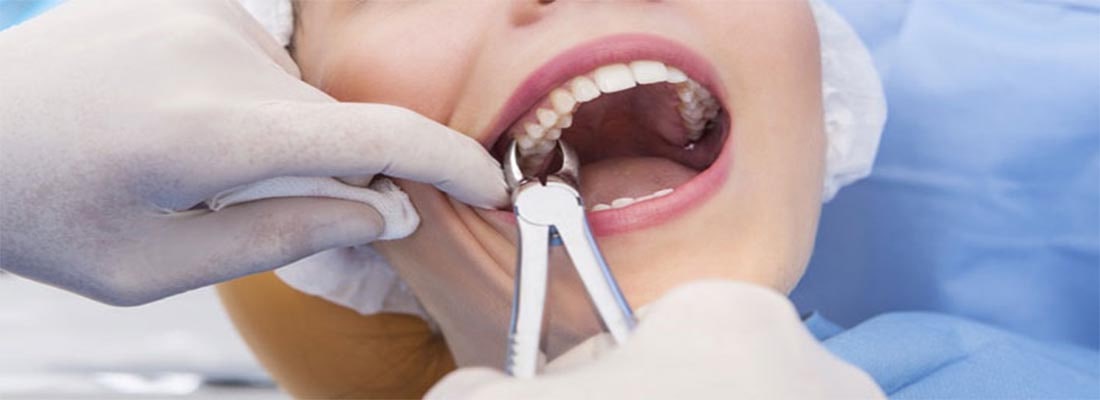 Сколько стоит удаление зубов