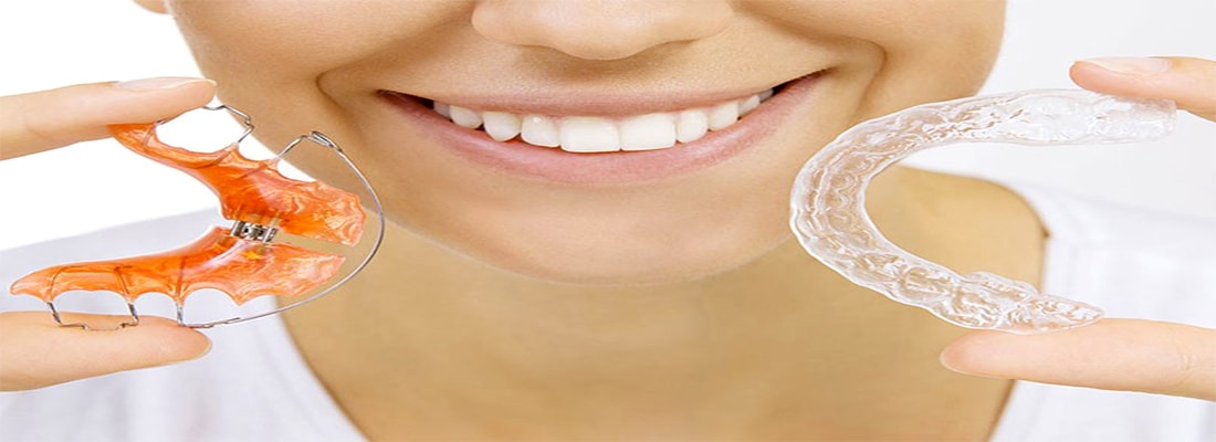 ортодонтические фиксаторы зубов