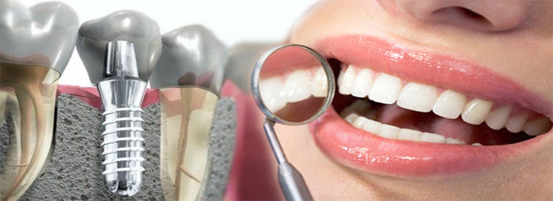 Подготовка к имплантации зубов